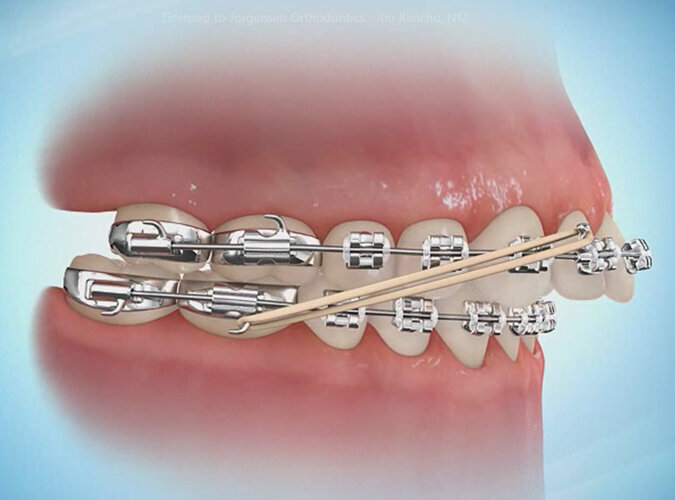 4 Orthodontic Terms to know: Elastics, Invisalign, TMJ, Phase 1 & 2 -  Sherman & Balhoff Orthodontics